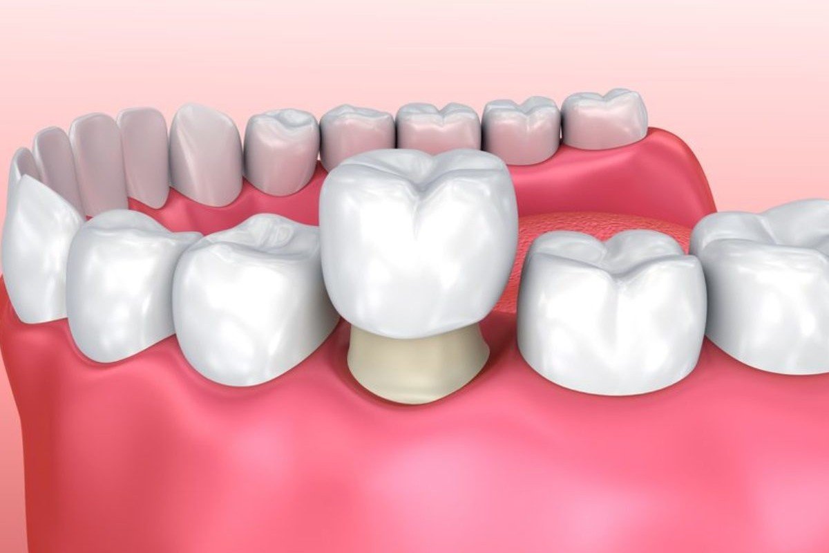 Dental Crown Treatment in India - Need, Types, Cost, and Procedure